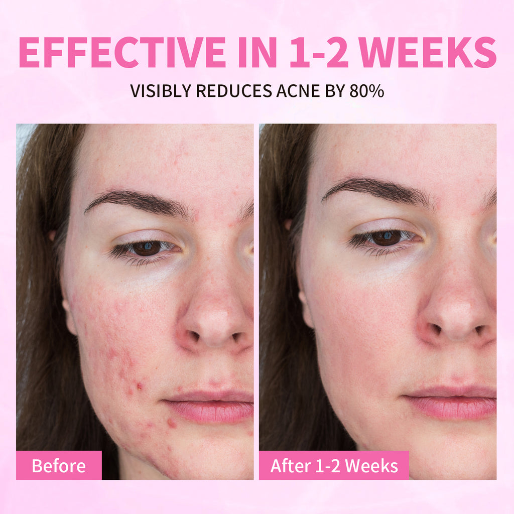 Precision Acne Spot Serum