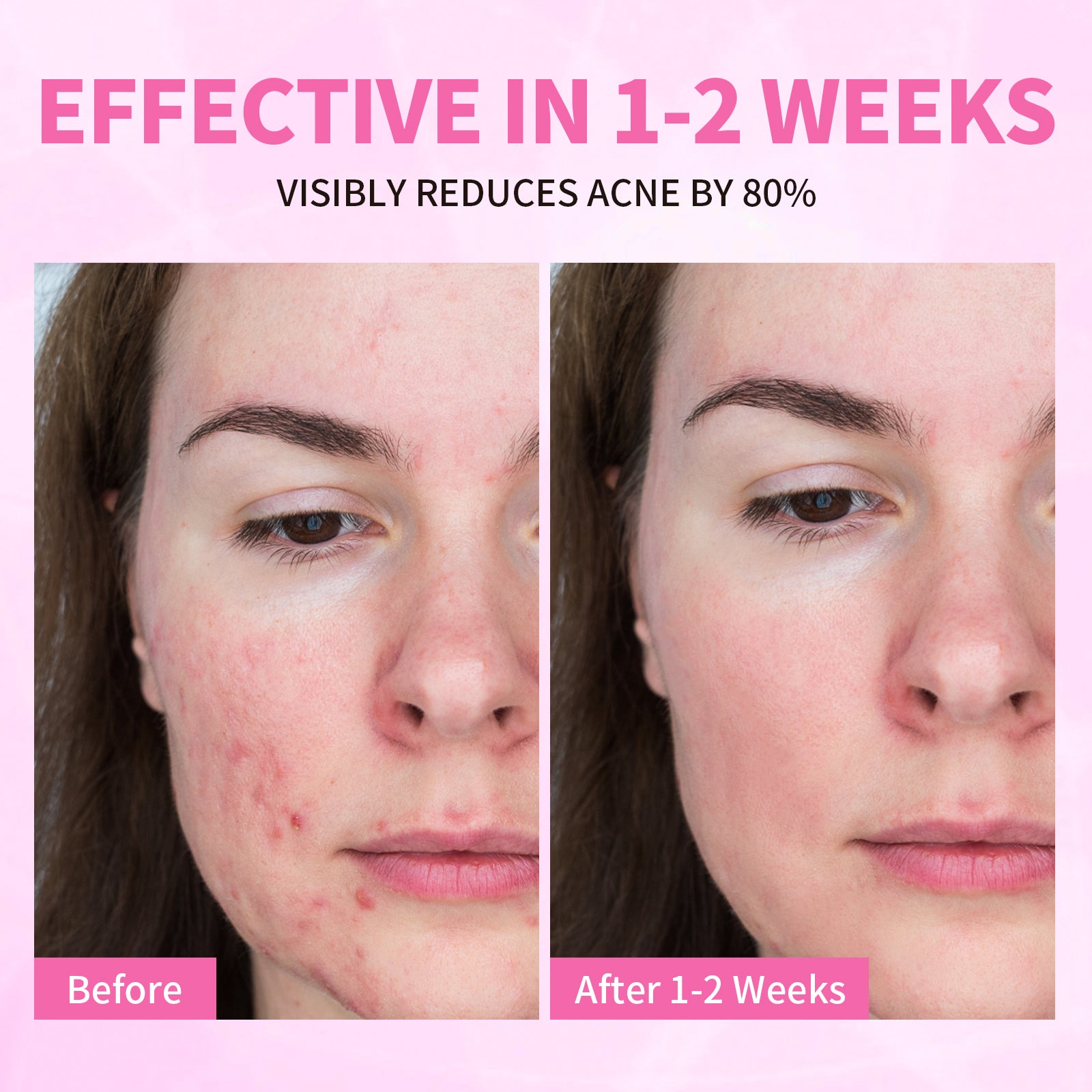 Precision Acne Spot Serum
